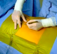 3M Ioban 2 anti-microbiële incisiefolie 