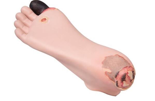 Decubitus verzorgingsmodel voet