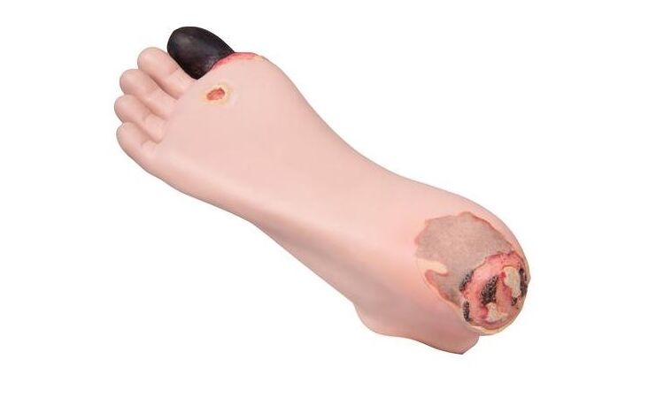 Decubitus verzorgingsmodel voet - afbeelding 0
