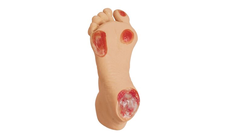 Oudere decubitus voet - afbeelding 0