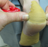 Preventief tapen van blaren met leukoplast