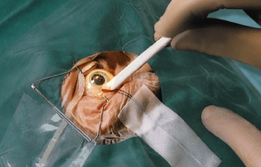 Lohmann Rauscher Pro-ophta oogstaafjes 66 x 5 mm steriel per 20 x 20st. verpakt - afbeelding 2