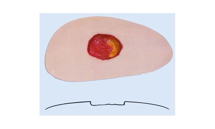 wondzorg model rode wond per stuk - afbeelding 0