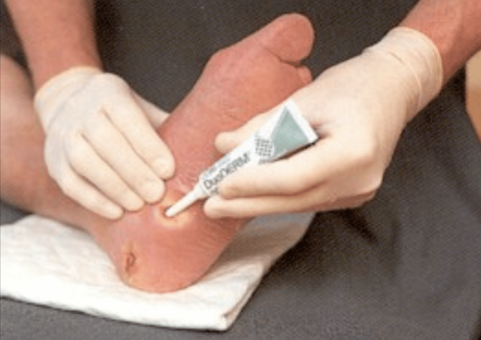 duoderm hydrogel met applicator