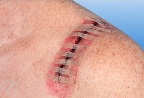 Noba rudanaht hechtstrip 100 x 13 mm steriel per 50x4st - afbeelding 1