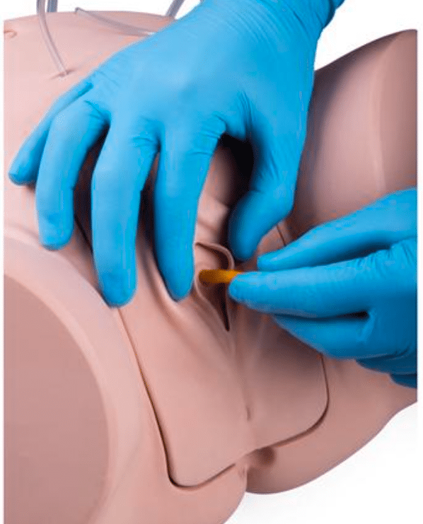 Katheter inbrengen bij vrouwen