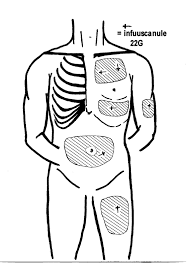 Surflo vleugelnaald voor subcutane infusie per 50st. - afbeelding 1